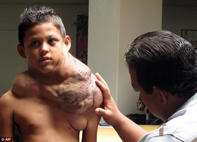 Bé Jose cùng khối u khổng lồ có từ lúc chào đời.