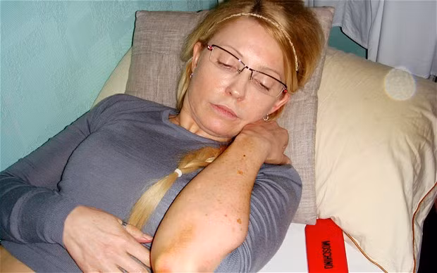 Bà Tymoshenko cho xem vết bầm tím ở tay do nhân viên nhà tù gây ra.