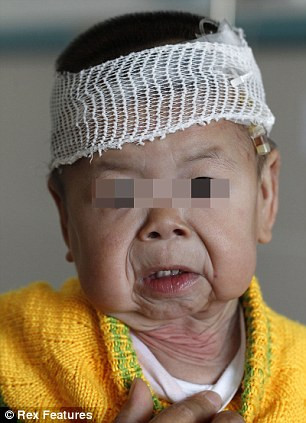 Bé Hiểu Lệ và ngoại hình biến dạng do mắc phải căn bệnh nhão da hiếm gặp. Bé Hiểu Lệ và ngoại hình biến dạng do mắc phải căn bệnh nhão da hiếm gặp.