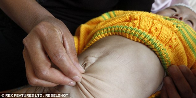 Bệnh tình của bé Yuxin ngày càng xấu đi nhưng cô bé vẫn rất sống động. Bệnh tình của bé Yuxin ngày càng xấu đi nhưng cô bé vẫn rất sống động.