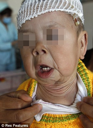 Bệnh khiến da bé Lệ trở nên nhão và đầy nếp gấp. Bệnh khiến da bé Lệ trở nên nhão và đầy nếp gấp.