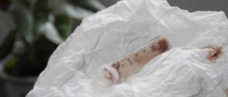 Ống tiêm ông Zhang nôn ra 4 giờ sau ca phẫu thuật ngày 22/4.