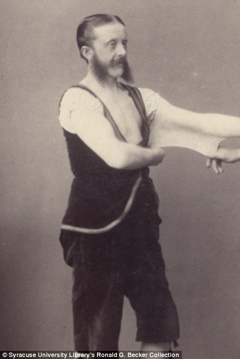 Felix Wehrle - người có da đàn hồi, có thể kéo căng tùy ý, do mắc phải hội chứng Ehlers-Danlos. Felix Wehrle - người có da đàn hồi, có thể kéo căng tùy ý, do mắc phải hội chứng Ehlers-Danlos.