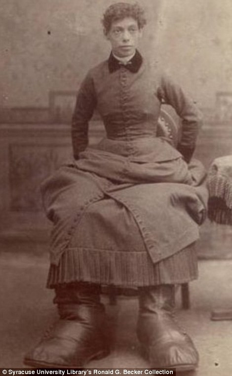 Fanny Mills có biệt danh "chân to" có nhiều khả năng mắc bệnh Milroy gây phù chân. Fanny Mills có biệt danh "chân to" có nhiều khả năng mắc bệnh Milroy gây phù chân.