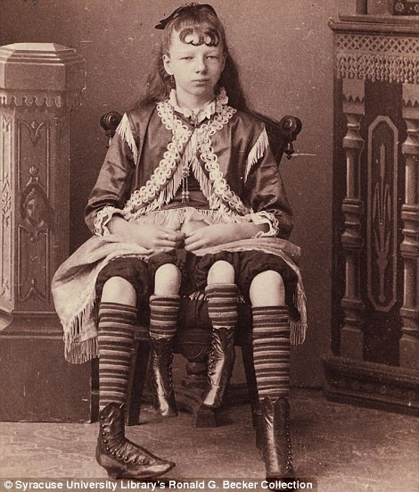 Myrtle Corbin - cô gái có 4 chân và 2 cơ quan sinh dục. Myrtle Corbin - cô gái có 4 chân và 2 cơ quan sinh dục.