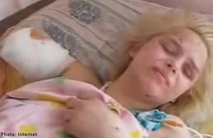 Oksana những ngày điều trị trong bệnh viện với những vết thương khủng khiếp ở cả thể chất lẫn tinh thần.