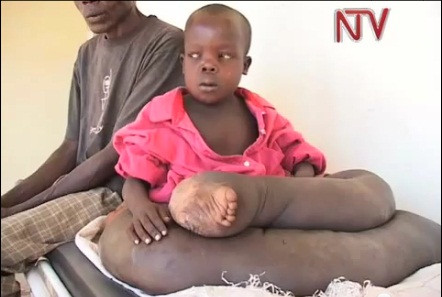 Hiện chỗ sưng vẫn tiếp tục phát triển khiến Vincent không thể đi lại được và phải mặc váy thay quần.