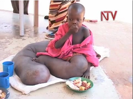 Tito Opoya, bố của Vincent cho biết, gia đình đã nhận thấy những bất thường ở con từ lúc cậu mới được 18 tháng tuổi. Tuy nhiên vì quá nghèo nên họ không có tiền đưa con đi khám bệnh.