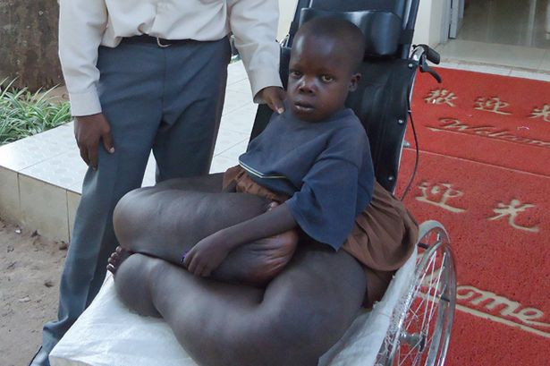 Tuy nhiên, chỗ sưng lại khiến cậu bé bị trật khớp hông và gãy mắt cá chân.