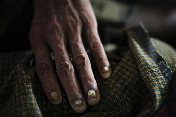 Bàn tay của một bệnh nhân nhiễm HIV tại nhà tế bần ở ngoại ô thành phố Yangon, Myanmar ngày 26/5/2012.