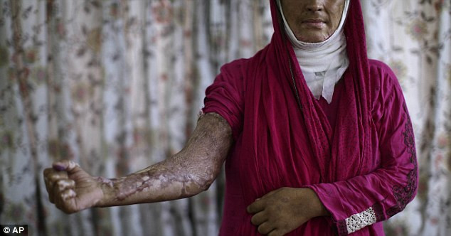 Sajda Ansar, 26 tuổi, cho xem vết bỏng bị chồng thiêu hồi tháng 4 năm ngoái khi phản đối việc anh ta dùng ma túy. Sajda Ansar, 26 tuổi, cho xem vết bỏng bị chồng thiêu hồi tháng 4 năm ngoái khi phản đối việc anh ta dùng ma túy.