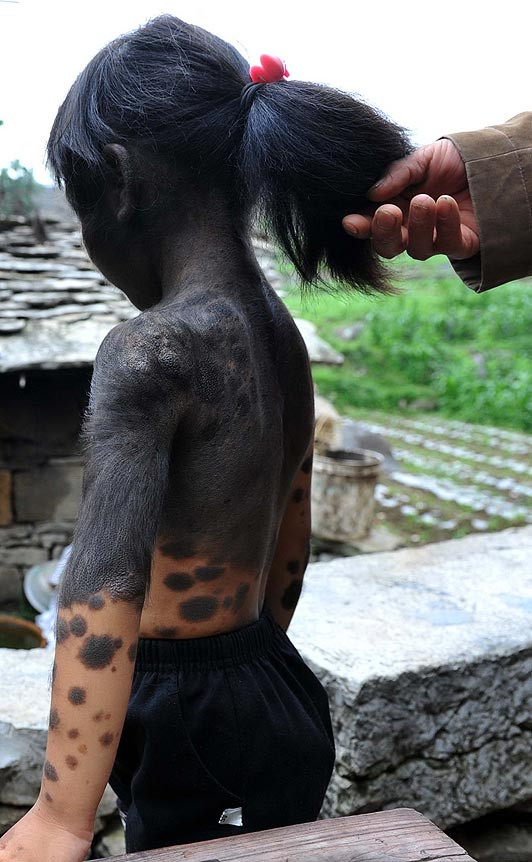 Bé Liu đã may mắn được một người họ hàng đón về nuôi nấng. Bé Liu đã may mắn được một người họ hàng đón về nuôi nấng.