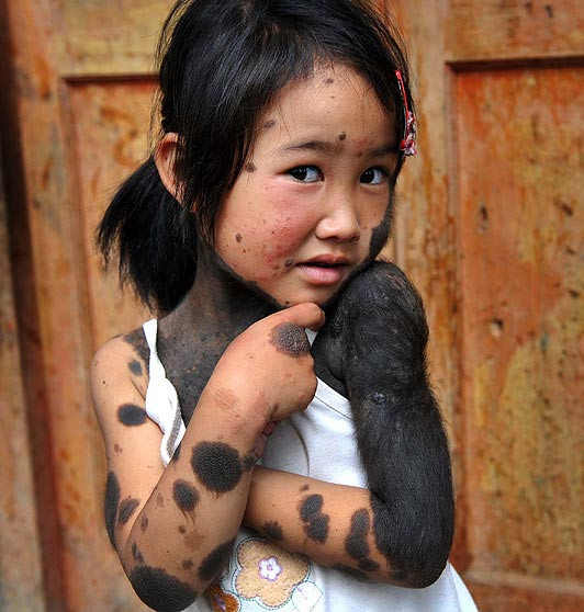 Bé Liu Jiangli bị cha mẹ đẻ bỏ rơi vì mắc mọc lông bất thường trên hơn 60% cơ thể. Bé Liu Jiangli bị cha mẹ đẻ bỏ rơi vì mắc mọc lông bất thường trên hơn 60% cơ thể.