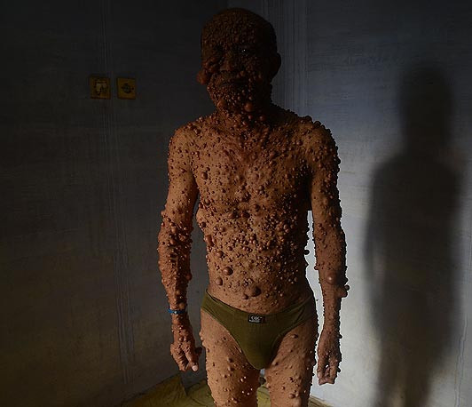 Toàn bộ cơ thể ông Lauw được bao phủ bởi những khối u lành tính