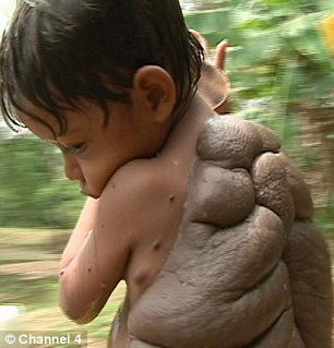 Nốt ruồi khổng lồ này đe dọa mạng sống và cản trở sự phát triển của cậu bé. Nốt ruồi khổng lồ này đe dọa mạng sống và cản trở sự phát triển của cậu bé.