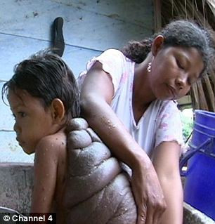 Nó chiếm tới 3/4 cơ thể Didier và là nguyên nhân khiến gia đình em bị xa lánh. Nó chiếm tới 3/4 cơ thể Didier và là nguyên nhân khiến gia đình em bị xa lánh.