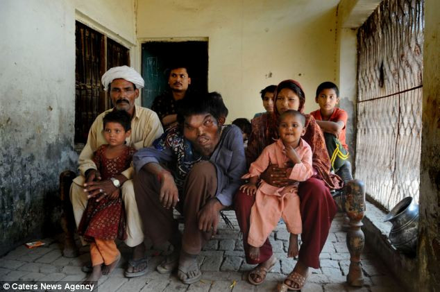 "Tôi đã như thế này từ lúc được sinh ra. Mặt, tay và chân đều ngoại cỡ. Mọi người nghĩ rằng tôi không như những người bình thường khác. Nhưng tinh thần của tôi rất bình thường và tôi hiểu tất cả mọi thứ..." - Sain tâm sự.