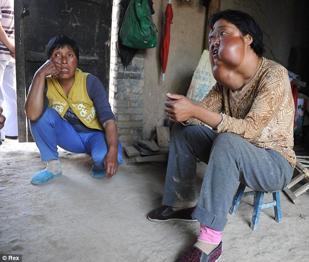 Khối u đã chầm chậm phát triển trên mặt Li suốt 10 năm qua và vẫn chưa ngừng lại.