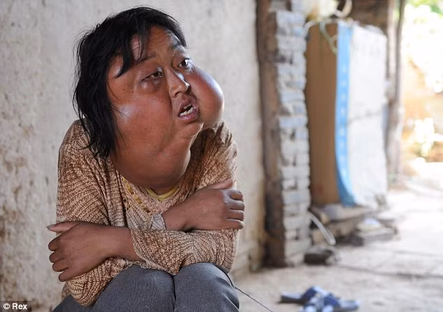 Li với khuôn mặt bị biến dạng vì 7 khối u mọc trên đó. Li với khuôn mặt bị biến dạng vì 7 khối u mọc trên đó.