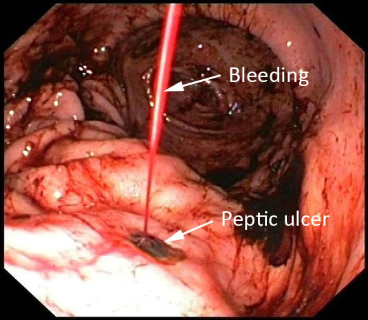 Hình ảnh dạ dày bị viêm loét và chảy máu.
