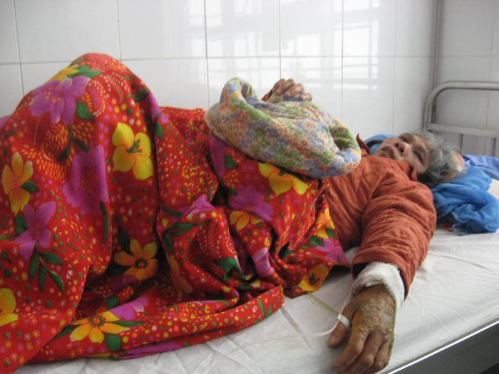 Hiện các vết bỏng trên người bà Phương đang tiến triển tốt đã khô và mọc da non