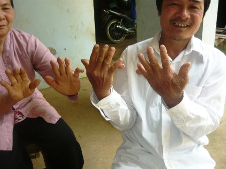 Hàng trăm người dân mang trên mình bàn tay, chân 6 ngón hoặc bị dính màng chân vịt. Ảnh: Lê Quyết Hàng trăm người dân mang trên mình bàn tay, chân 6 ngón hoặc bị dính màng chân vịt. Ảnh: Lê Quyết