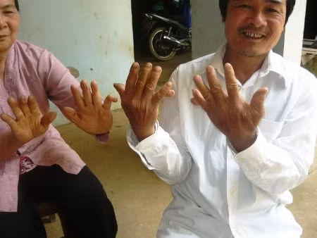 Hàng trăm người dân mang trên mình bàn tay, chân 6 ngón hoặc bị dính màng chân vịt. Ảnh: Lê Quyết