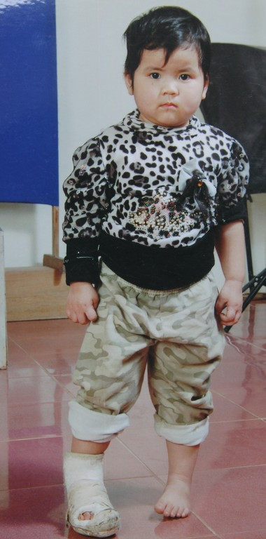 Cháu Mai Linh với vết thương ở chân phải Cháu Mai Linh với vết thương ở chân phải