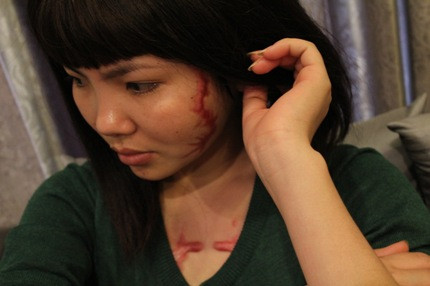 Theo nhận định, vết thương của cô gái đang có chuyển biến tích cực. Theo nhận định, vết thương của cô gái đang có chuyển biến tích cực.