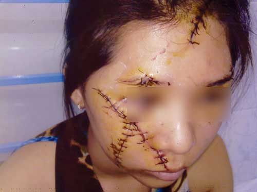 Khuông mặt chị Như đầy những vết thương do dao lam rạch nát