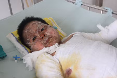 Khuôn mặt của bé Thảo bị cháy xạm đen do bỏng dầu đến 85% cơ thể