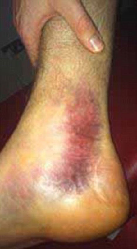 3. Per Mertesacker của Arsenal sẽ phải nghỉ 1 tháng vì bị sưng mắt cá trong trận gặp Sunderland hôm Chủ nhật vừa rồi. Anh đã bay về Đức để kiểm tra vết thương nên sẽ không có mặt trong trận gặp AC Milan ở Champions League và Sunderland ở FA Cup, và có thể là cả trận derby Bắc London với Tottenham ở giải Ngoại hạng. 3. Per Mertesacker của Arsenal sẽ phải nghỉ 1 tháng vì bị sưng mắt cá trong trận gặp Sunderland hôm Chủ nhật vừa rồi. Anh đã bay về Đức để kiểm tra vết thương nên sẽ không có mặt trong trận gặp AC Milan ở Champions League và Sunderland ở FA Cup, và có thể là cả trận derby Bắc London với Tottenham ở giải Ngoại hạng.