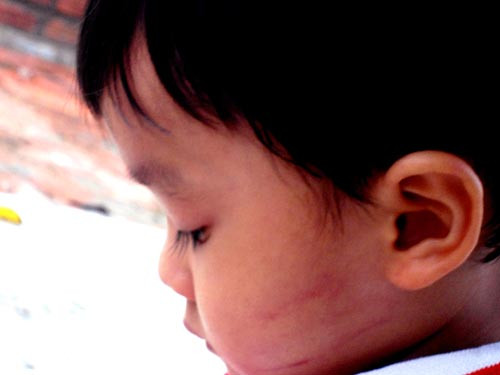Bé Thiên với khuôn mặt in vết bợp tai Bé Thiên với khuôn mặt in vết bợp tai