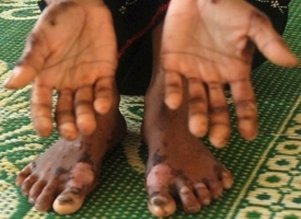 Bệnh “lạ” bùng phát, lan rộng