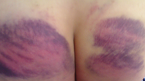 Thầy giáo ở Bảo Lộc, Lâm đồng đã dùng roi đánh dập mông 6 em HS do chưa làm bài tập