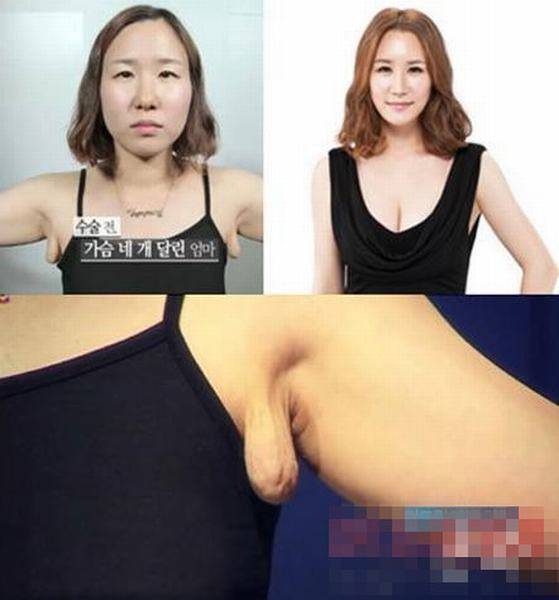 Phẫu thuật cắt lớp mõ thừa ở hai bên nách mà không để lại một dấu vết nào. Phẫu thuật cắt lớp mõ thừa ở hai bên nách mà không để lại một dấu vết nào.