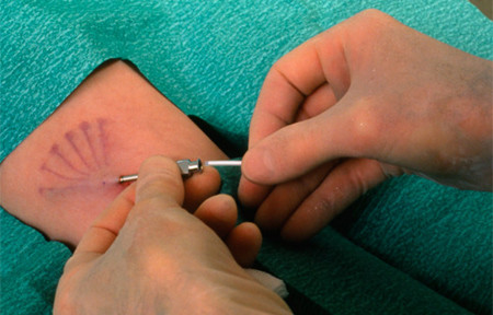 Phương pháp cấy que tránh thai đã được áp dụng với nhiều teen nữ ở 9 trường học tại Anh. Ảnh: Mirror Ảnh: Mirror.