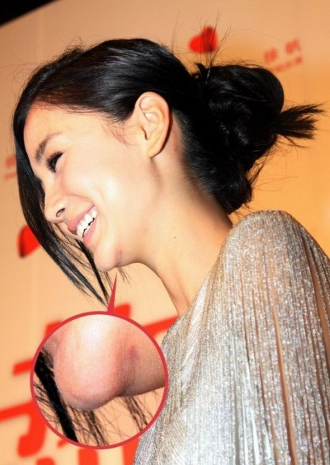 Vết sẹo do phẫu thuật còn hiện hữu rất rõ dưới cằm của Angela Baby. Vết sẹo do phẫu thuật còn hiện hữu rất rõ dưới cằm của Angela Baby.