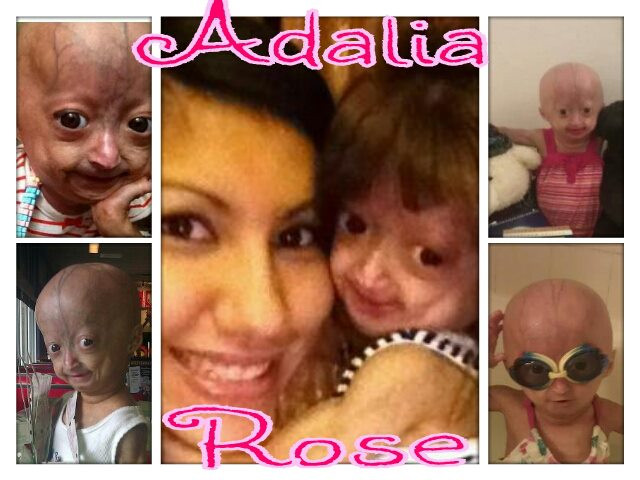 Căn bệnh kì lạ không những làm hình dạng của cô bé trở nên già và gớm giếc mà còn rụng hết tóc của em.