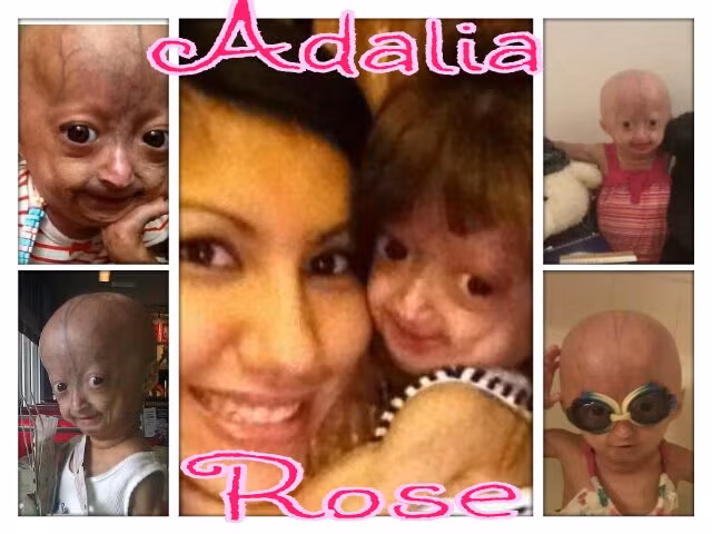 Căn bệnh kì lạ không những làm hình dạng của cô bé trở nên già và gớm giếc mà còn rụng hết tóc của em.