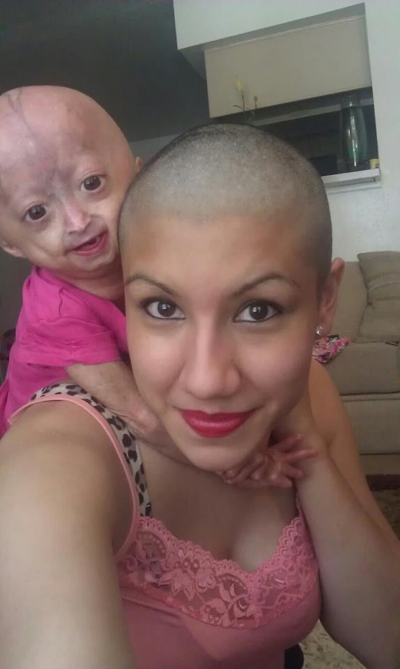 Mới chỉ 5 tuổi nhưng Adalia Rose có khuôn mặt và hình dáng của một bà già. Không hề mặc cảm với ngoại hình, cô bé vẫn sống rất vui vẻ bên gia đình và bạn bè. Bức ảnh cô chụp bên mẹ mình đang nhận được 2 triệu like.