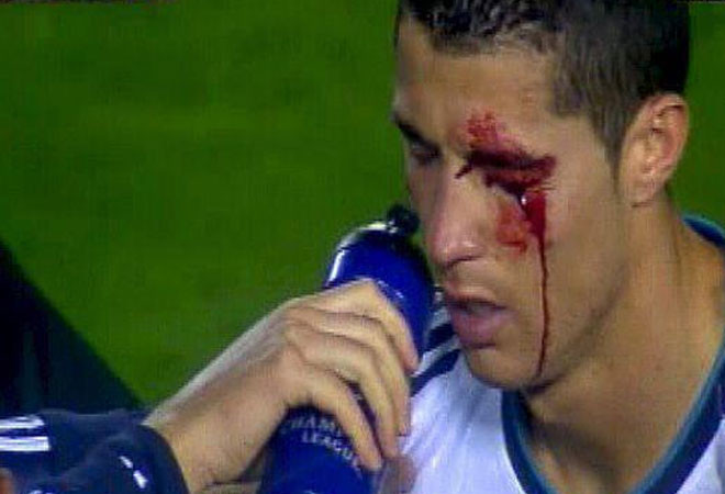 Ronaldo bị Navarro đánh chảy máu mặt. Ronaldo bị Navarro đánh chảy máu mặt.