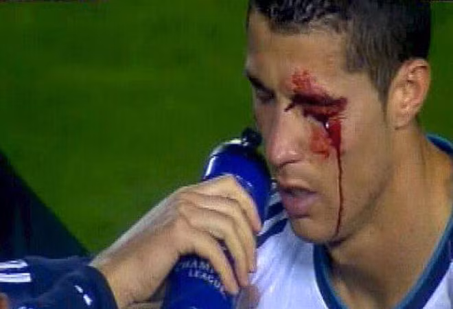 Ronaldo bị Navarro đánh chảy máu mặt.