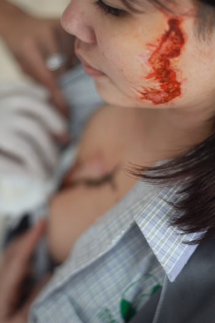G cần phải điều trị tốt về mặt tâm lý mới có thể thẩm mỹ lại vết tẩy xăm này