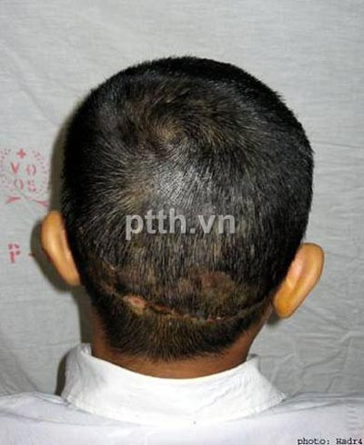 Sau khi nối da đầu, tóc bệnh nhân đã mọc lại. Ảnh do Khoa Phẫu thuật Tạo hình - Hàm mặt Bệnh viện Việt Đức cung cấp