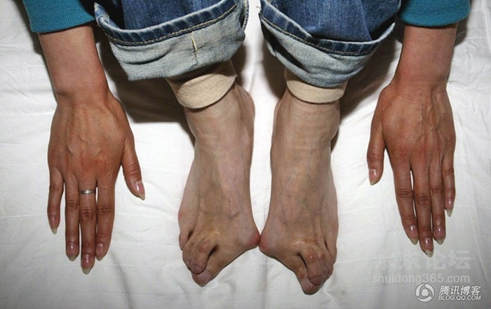 Trước phiên tòa kiện việc bị ăn chặn tiền lương và tiền thưởng, nữ vận động viên đã rơi nước mắt giơ đôi chân biến dạng đến mức gần như tàn phế vì cường độ tập luyện quá hà khắc.(Số phận nghiệt ngã sau ánh hào quang của những HCV thể thao Trung Quốc) Trước phiên tòa kiện việc bị ăn chặn tiền lương và tiền thưởng, nữ vận động viên đã rơi nước mắt giơ đôi chân biến dạng đến mức gần như tàn phế vì cường độ tập luyện quá hà khắc.(Số phận nghiệt ngã sau ánh hào quang của những HCV thể thao Trung Quốc)