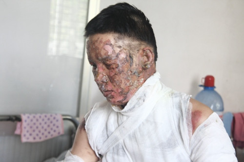 Ngọn lửa cồn bốc cháy làm bỏng toàn bộ khuôn mặt nạn nhân
