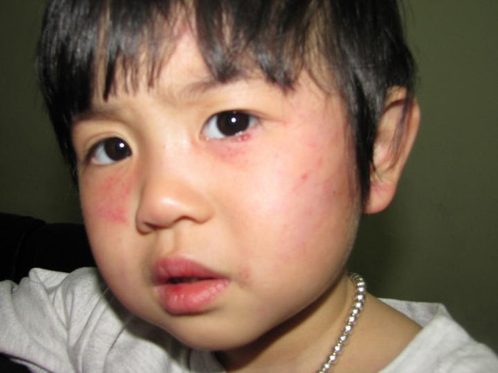 Bé Khánh Linh bị cô giáo dùng thước đánh vào mặt Bé Khánh Linh bị cô giáo dùng thước đánh vào mặt