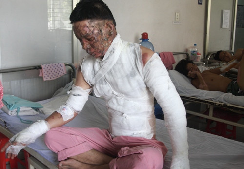 Ngoài ra, cổ, thân và hai tay đều bị bỏng nặng
