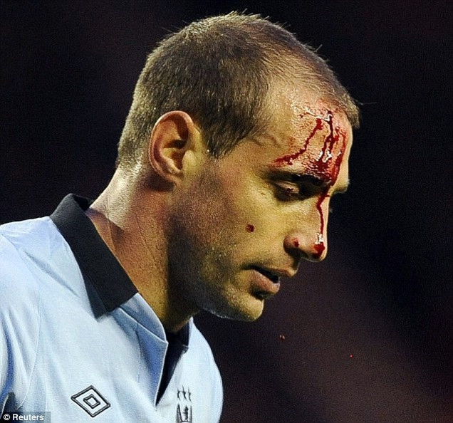 Pablo Zabaleta chảy máu đầu ở hiệp 1 trận Sunderland - Man City và phải nhờ các nhân viên y tế băng đầu trước khi trở lại sân. Sunderland thắng 1-0 nhờ công của cựu cầu thủ Man City, Adam Johnson. Pablo Zabaleta chảy máu đầu ở hiệp 1 trận Sunderland - Man City và phải nhờ các nhân viên y tế băng đầu trước khi trở lại sân. Sunderland thắng 1-0 nhờ công của cựu cầu thủ Man City, Adam Johnson.
